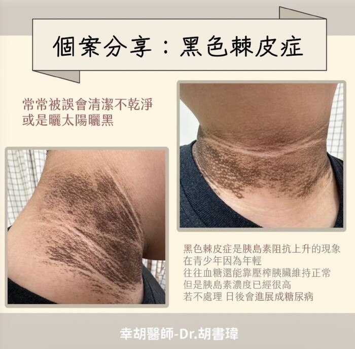 黑色棘皮症